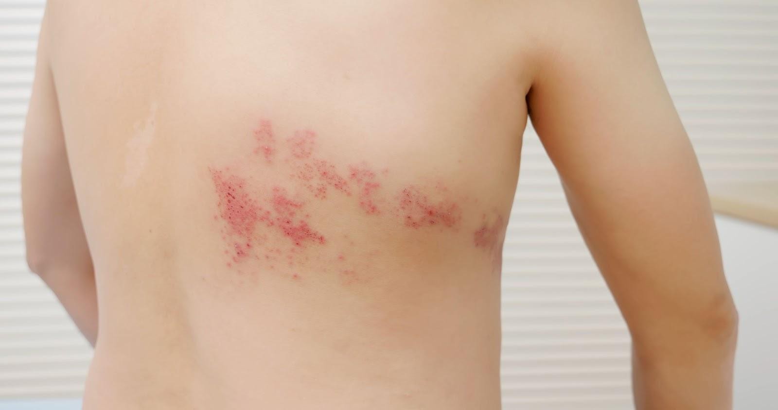 Symptoms of Shingles Singapore