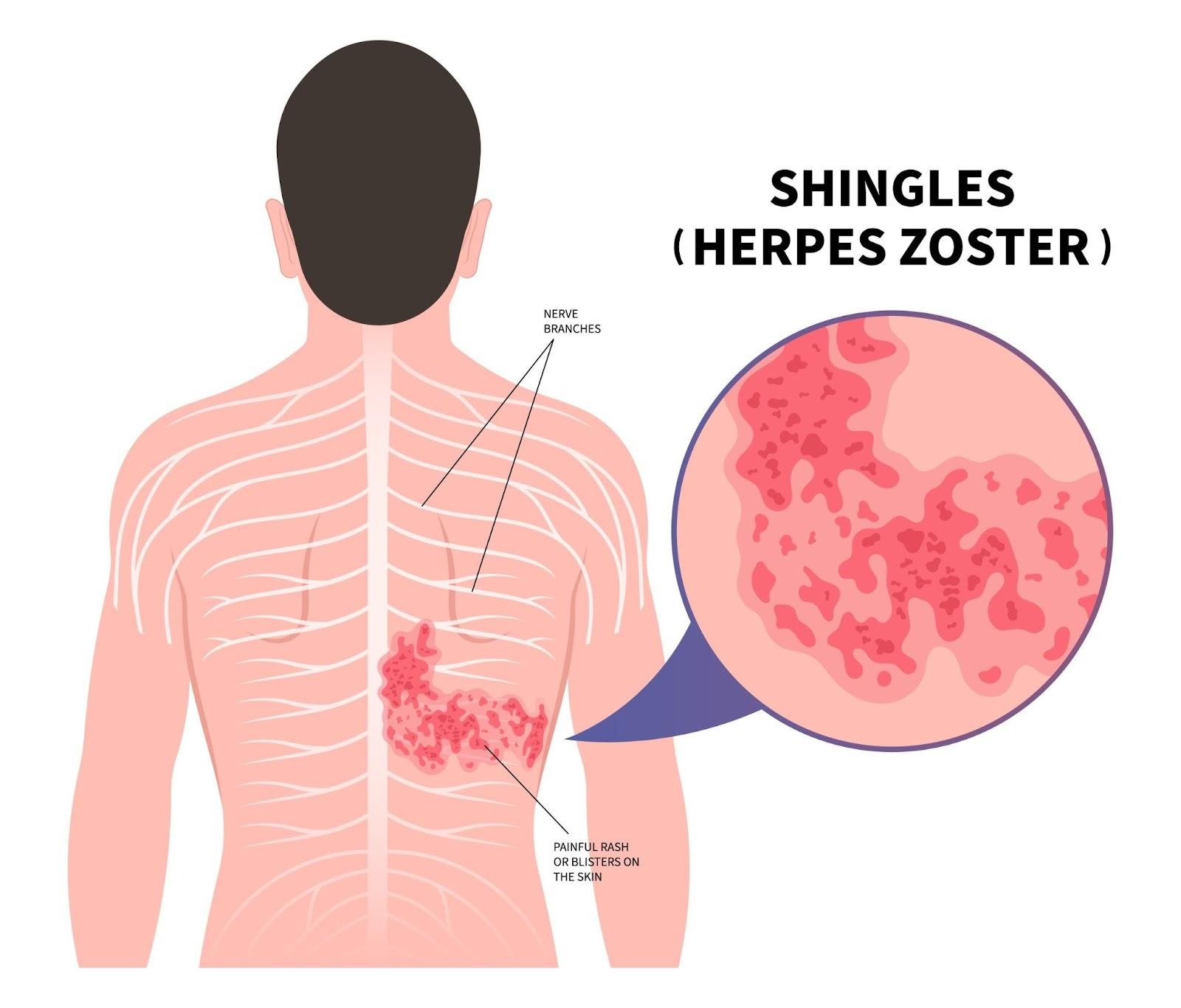 Shingles Singapore