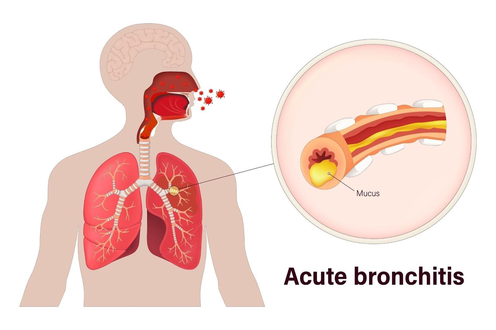 Acute Bronchitis Singapore