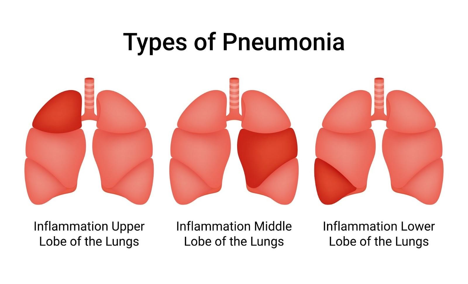 Pneumococcal Disease Singapore
