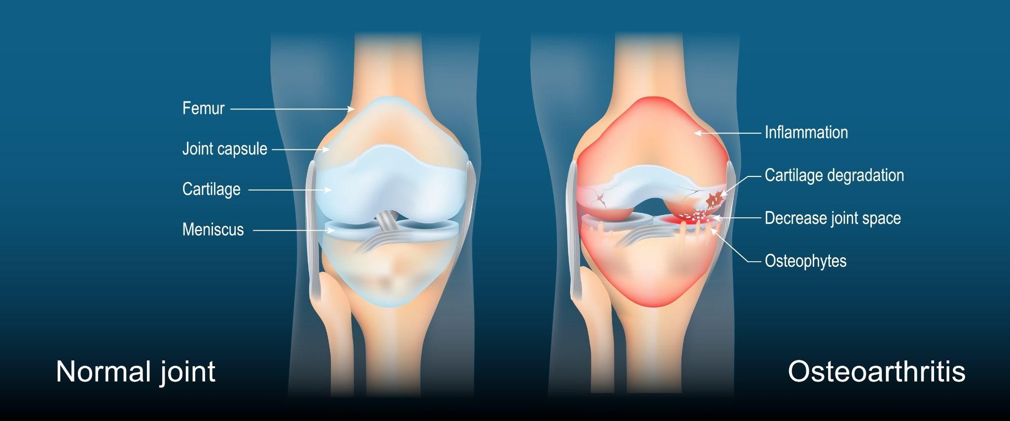 Causes of Chronic Knee Pain Singapore