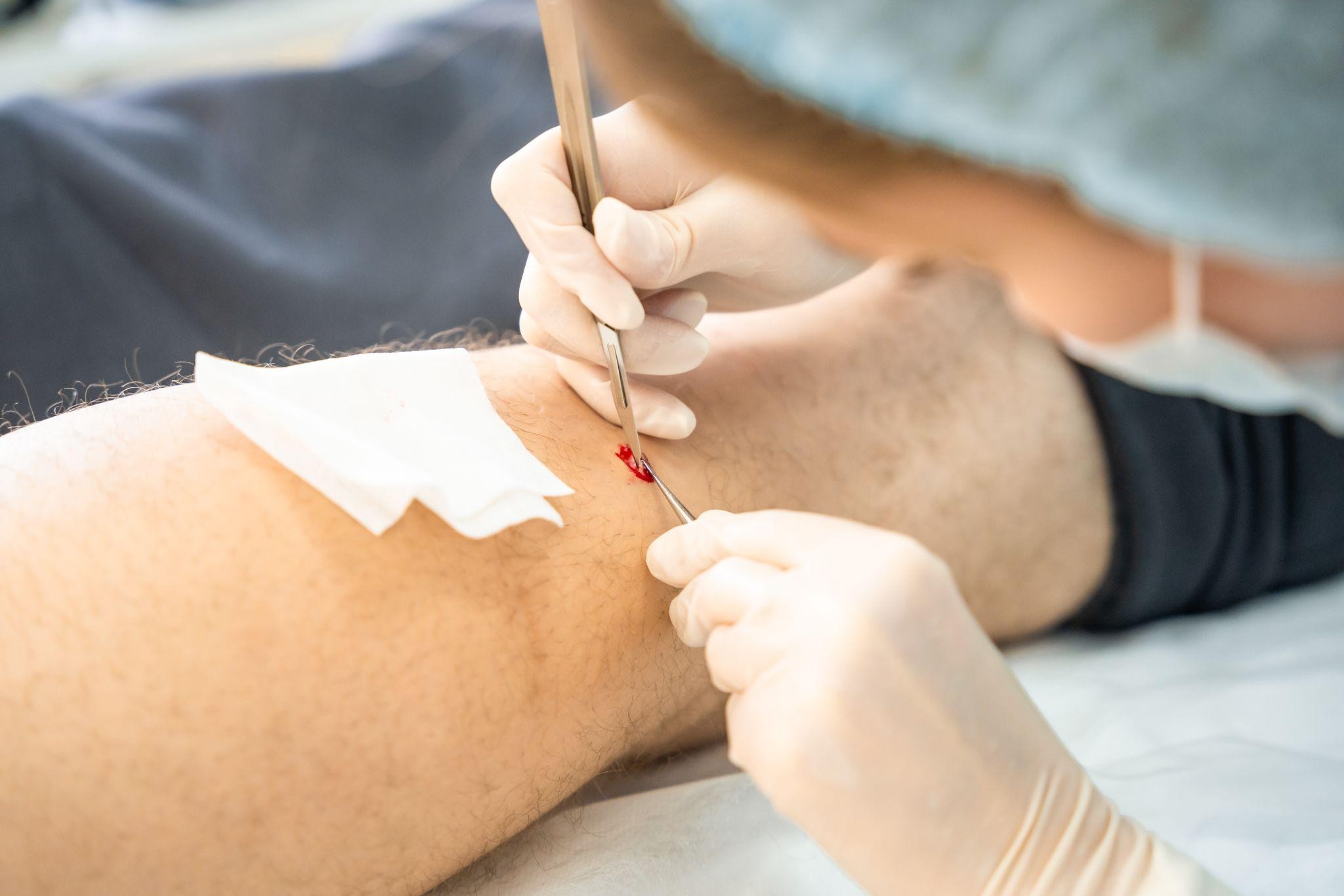 Incision and Drainage (I&D) Singapore